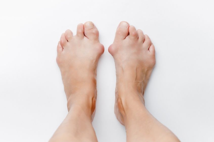 Biến dạng khớp ngón chân