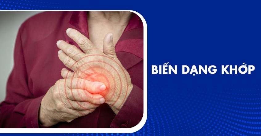 Biến dạng khớp: Nguyên nhân, triệu chứng và cách phòng ngừa