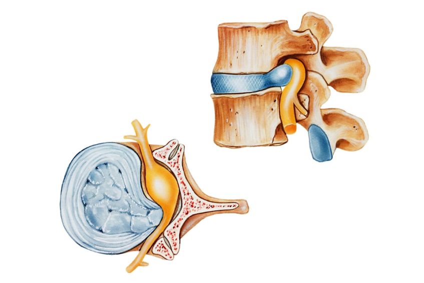 Thoát vị đĩa đệm gây đau cổ vai gáy