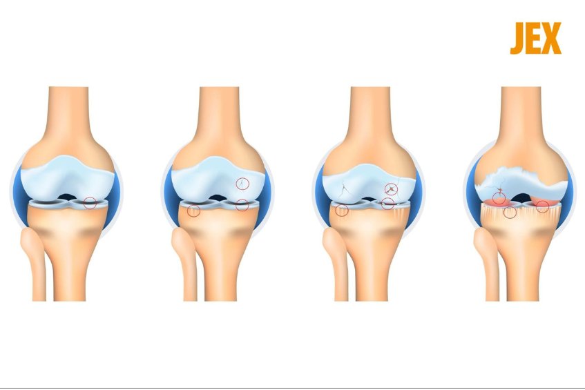 Nguyên nhân gây viêm khớp gối ở người già