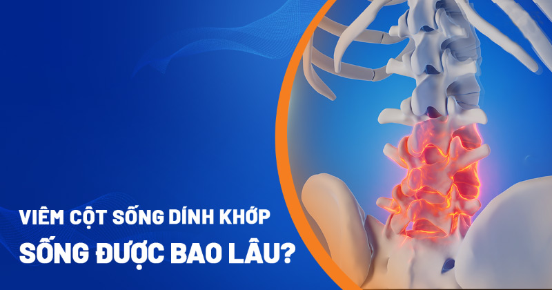 Viêm cột sống dính khớp sống được bao lâu? Yếu tố nào quyết định?