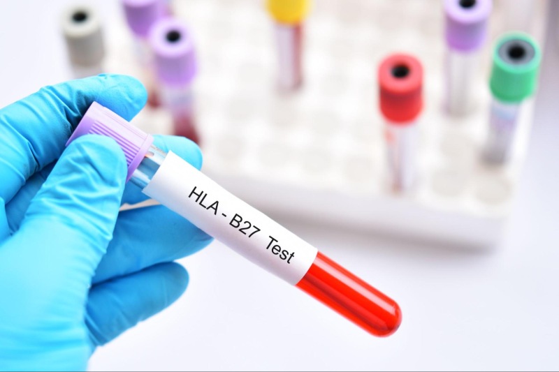 Xét nghiệm HLA-B27 phát hiện viêm cột sống dính khớp