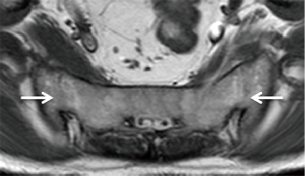 Hình ảnh Mri viêm khớp cùng chậu