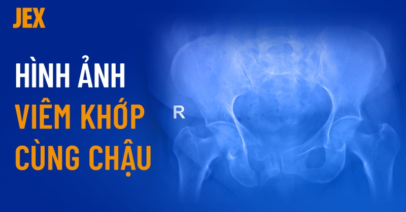 Hình ảnh viêm khớp cùng chậu trên X quang qua từng giai đoạn