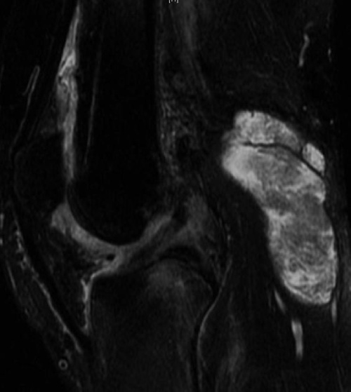 Chụp MRi ở khớp gối