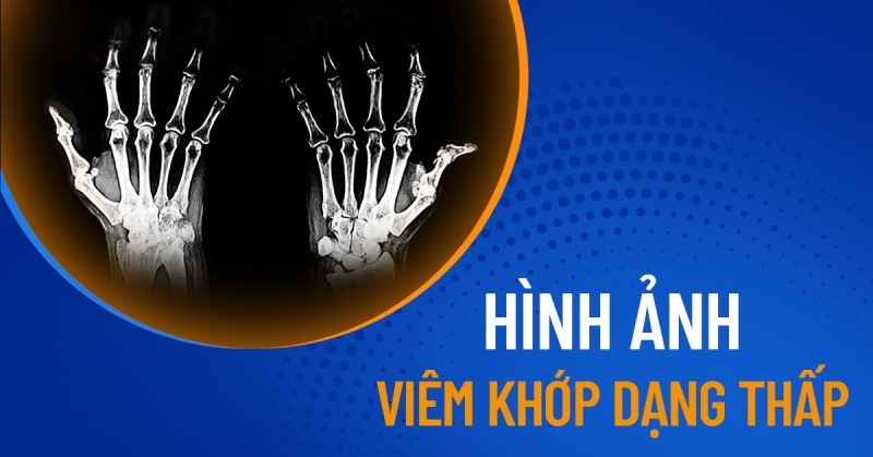 Hình ảnh viêm khớp dạng thấp ở nhiều vị trí khác nhau trên cơ thể