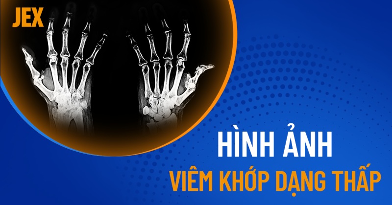 Hình ảnh viêm khớp dạng thấp ở nhiều vị trí khác nhau trên cơ thể