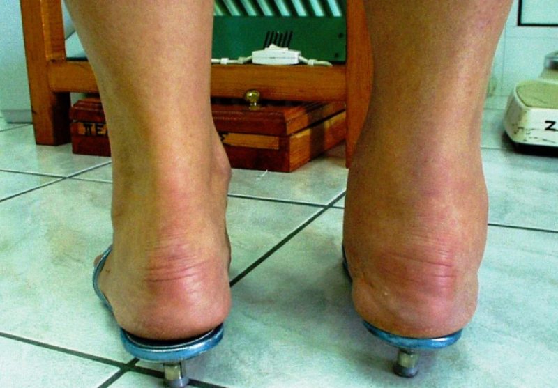 Sưng nóng khớp chân