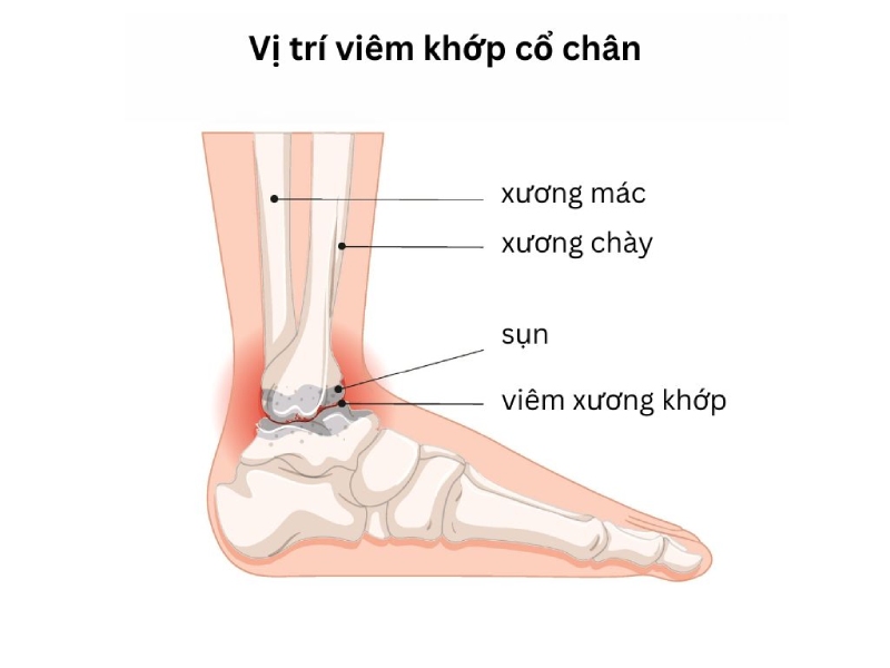 Vị trí viêm khớp cổ chân