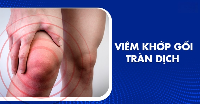 Viêm khớp gối tràn dịch: Nguyên nhân, dấu hiệu và cách điều trị