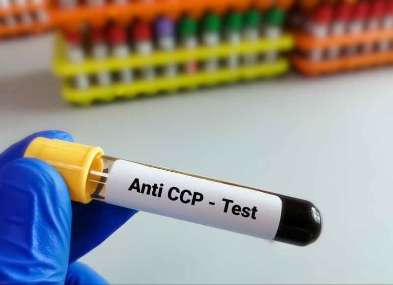 Xét nghiêm anti CCP test