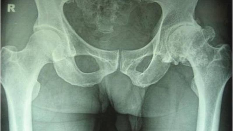 Biến dạng xương đùi trái