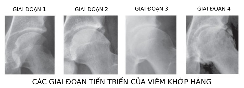 giai đoạn tiến triển của viêm khớp háng