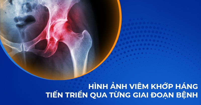 Hình ảnh viêm khớp háng tiến triển qua từng giai đoạn của bệnh