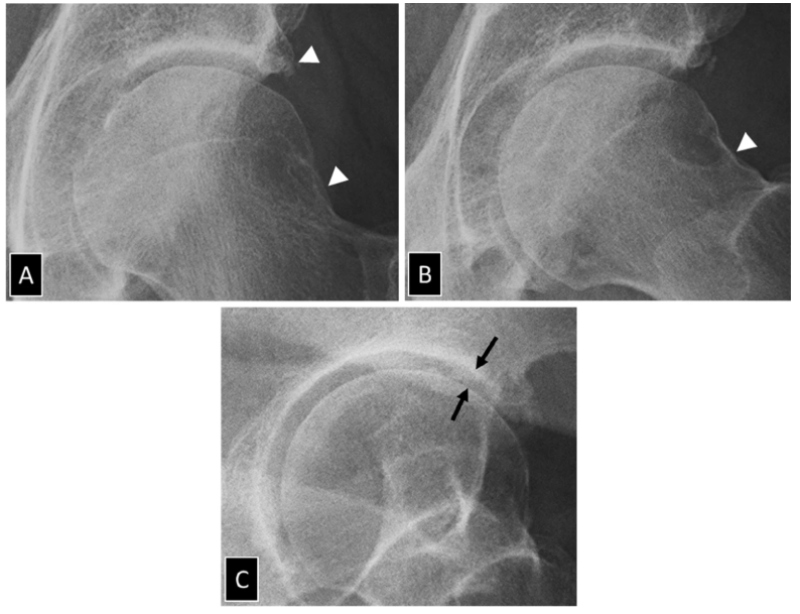 Khoảng cách các khớp