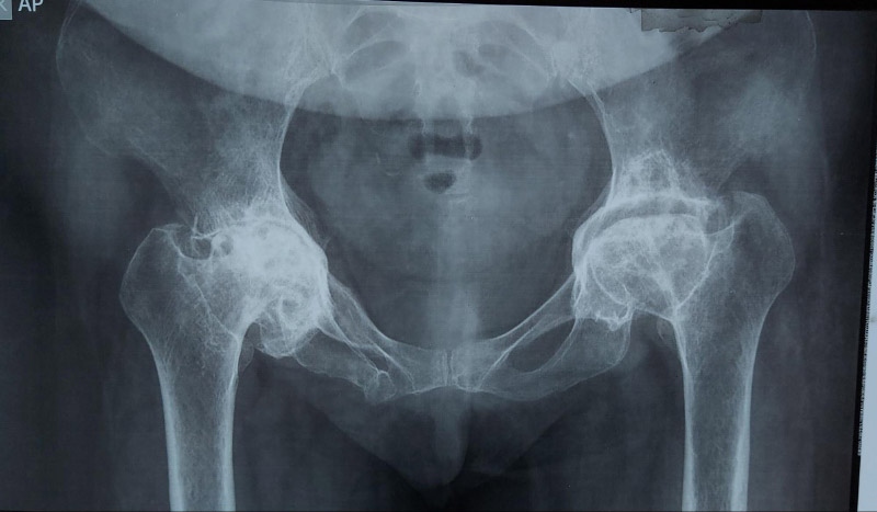 Mất hoàn toàn khe khớp