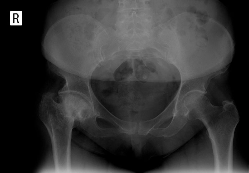 xương cùng bên dưới sụn