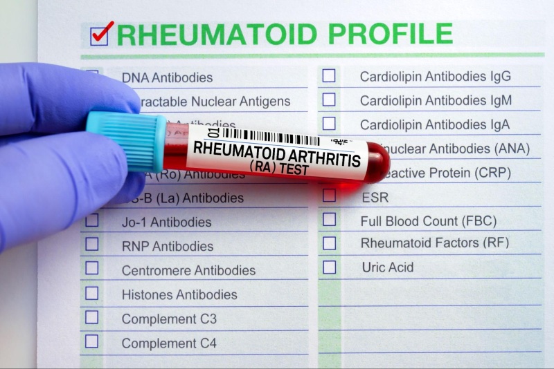 Chỉ số xét nghiệm máu RF