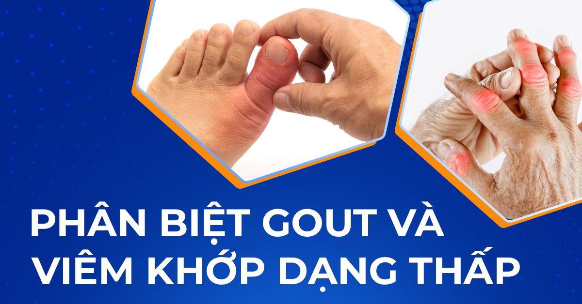 Hướng dẫn phân biệt gout và viêm khớp dạng thấp chi tiết [So sánh]