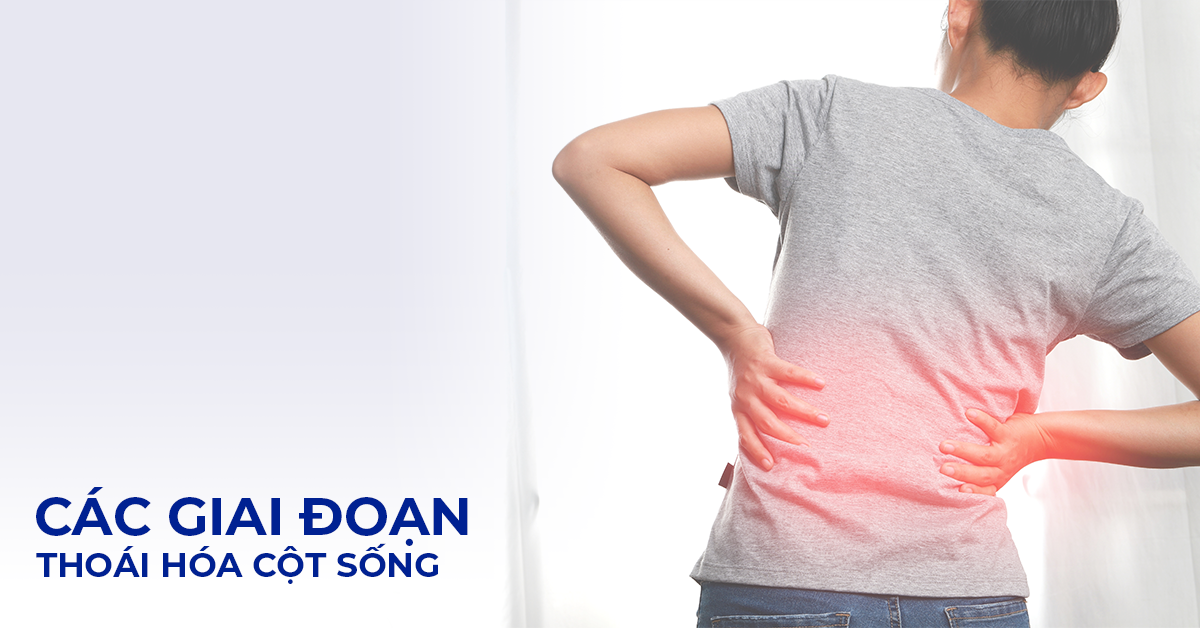 Các giai đoạn thoái hóa cột sống tiến triển từ nhẹ đến nặng