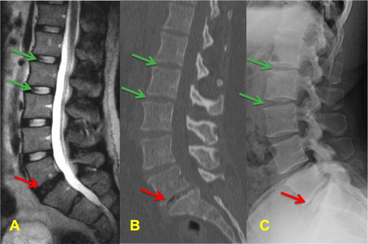 Hình ảnh CT thoái hóa cột sống thắt lưng