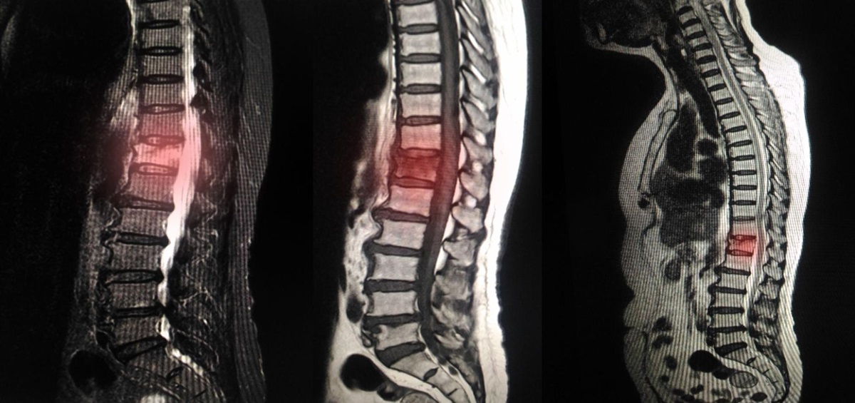 Hình ảnh MRI cột sống xuát hiện xơ cứng dưới sụn