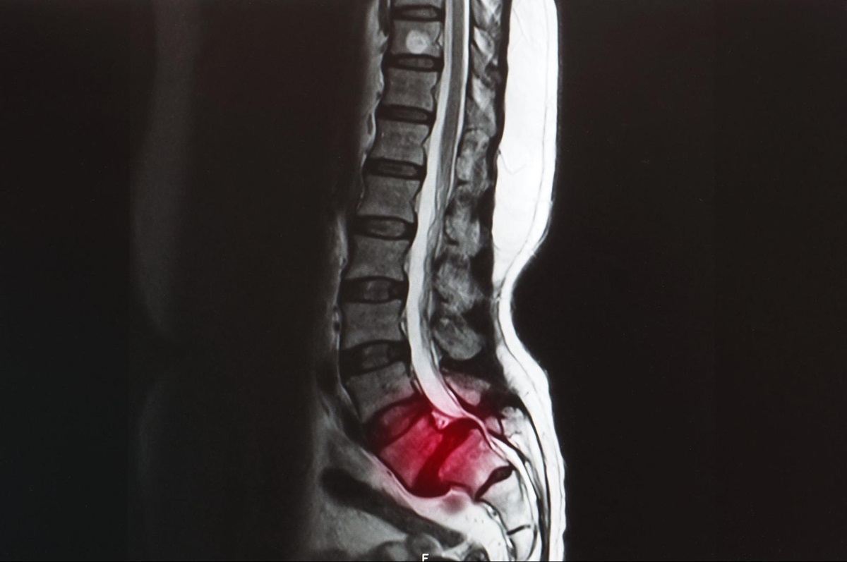 Hình ảnh MRI thoái hóa cột sống bị trượt đốt sống