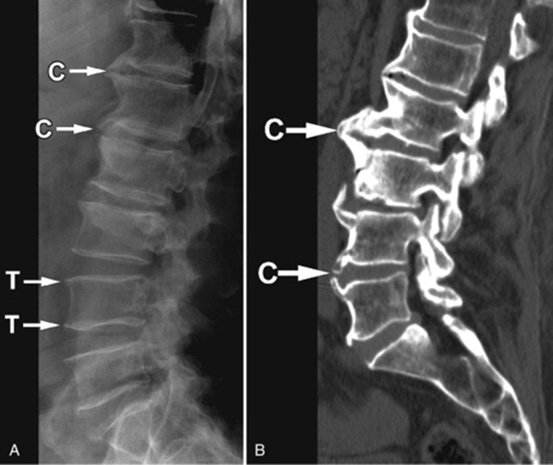 Hình ảnh X-quang cột sống bị thoái hóa​ có các gai xương