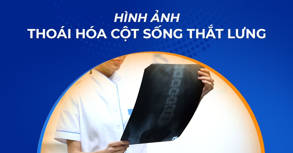 Hình ảnh thoái hóa cột sống thắt lưng qua X Quang, MRI, CT