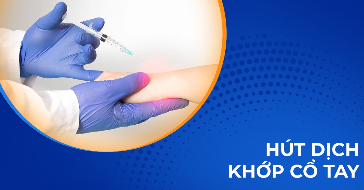 Chọc hút dịch khớp cổ tay: Quy trình, kỹ thuật, chi phí thực hiện