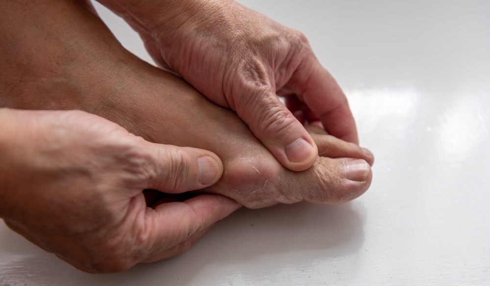 Gout cũng gây đau nhức xương khớp người lớn tuổi