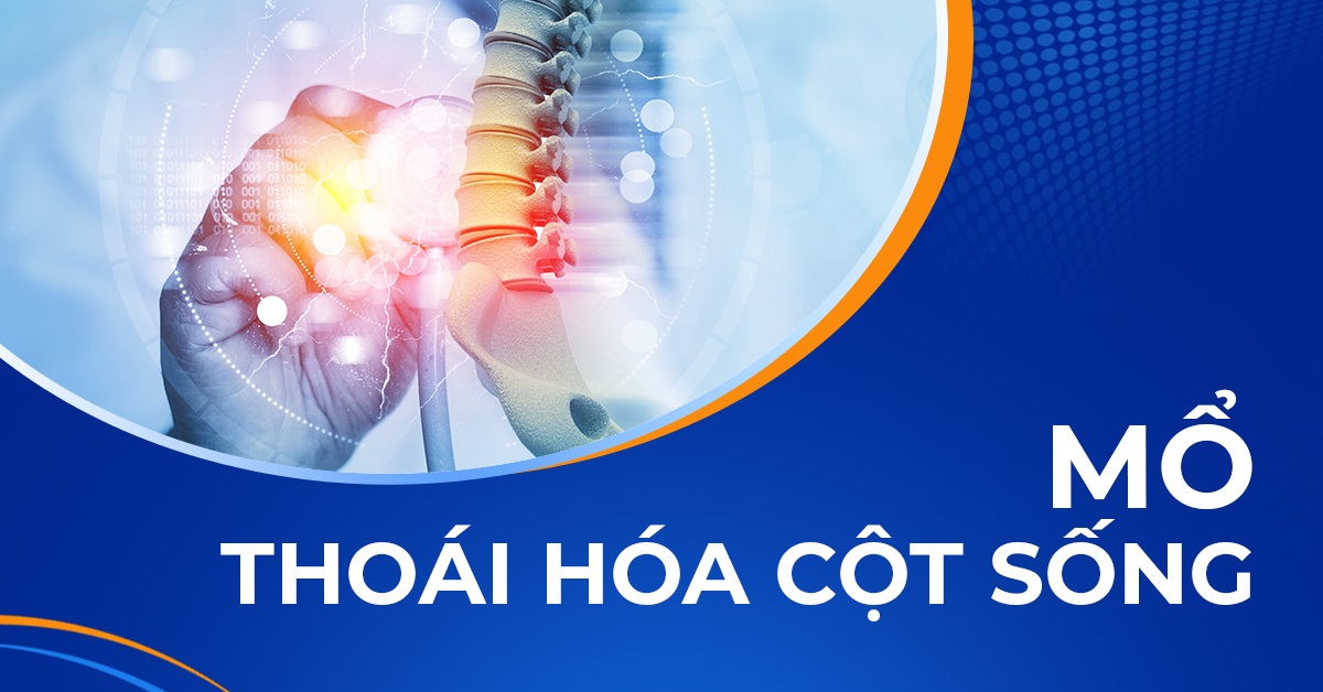 Mổ thoái hóa cột sống bao nhiêu tiền? Quy trình thực hiện ra sao?