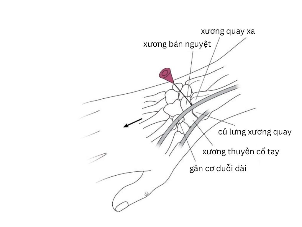 Vị trí chọc hút dịch khớp cổ tay