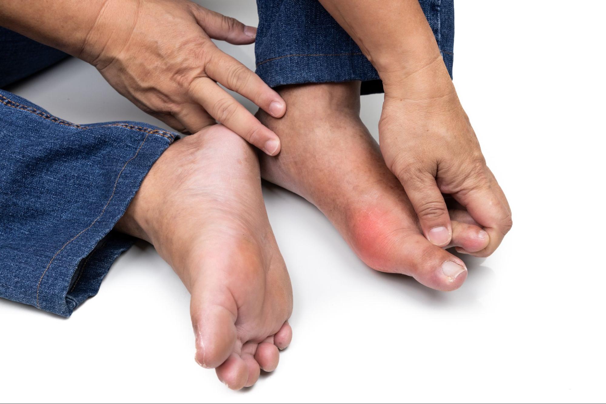 bệnh gout