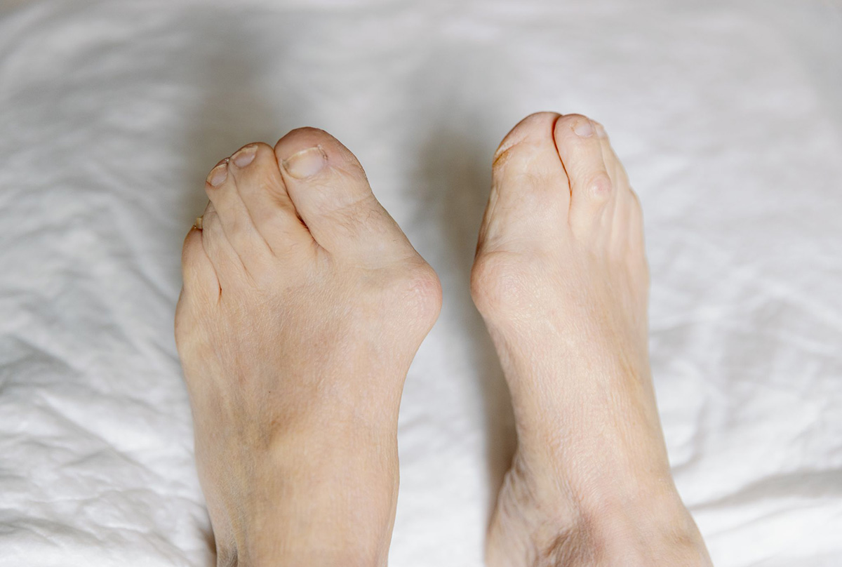 biến dạng khớp