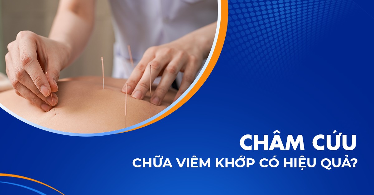 châm cứu chữa viêm khớp​