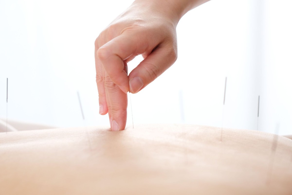 châm cứu là phương pháp hỗ trợ chữa viêm khớp