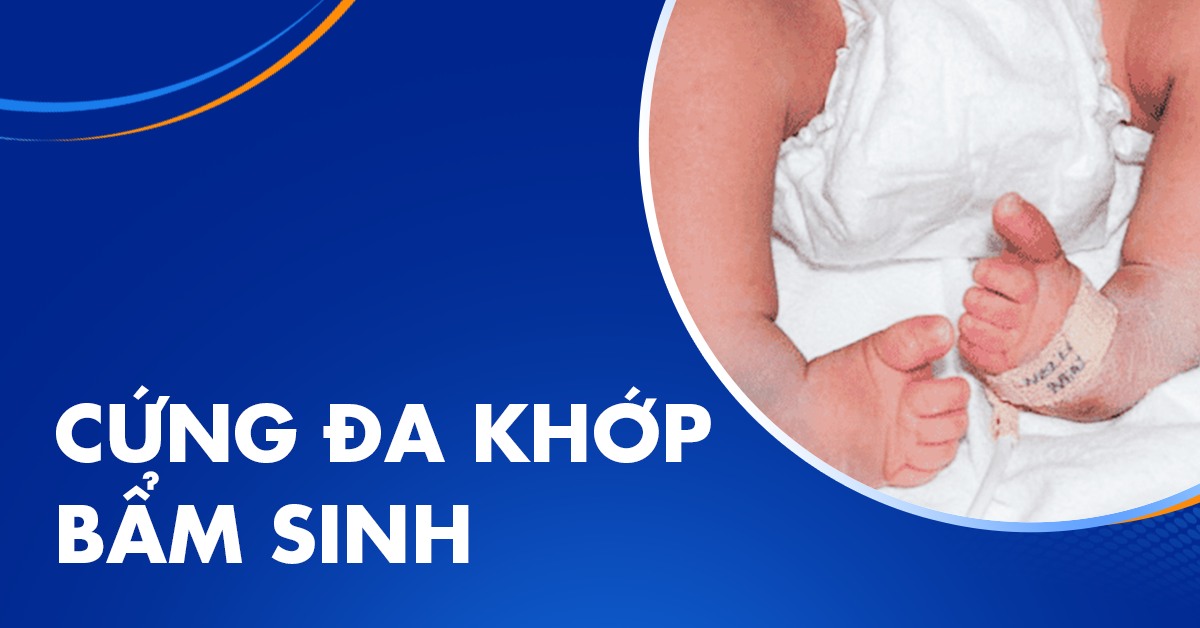 Cứng đa khớp bẩm sinh ở trẻ: Những điều cha mẹ cần biết