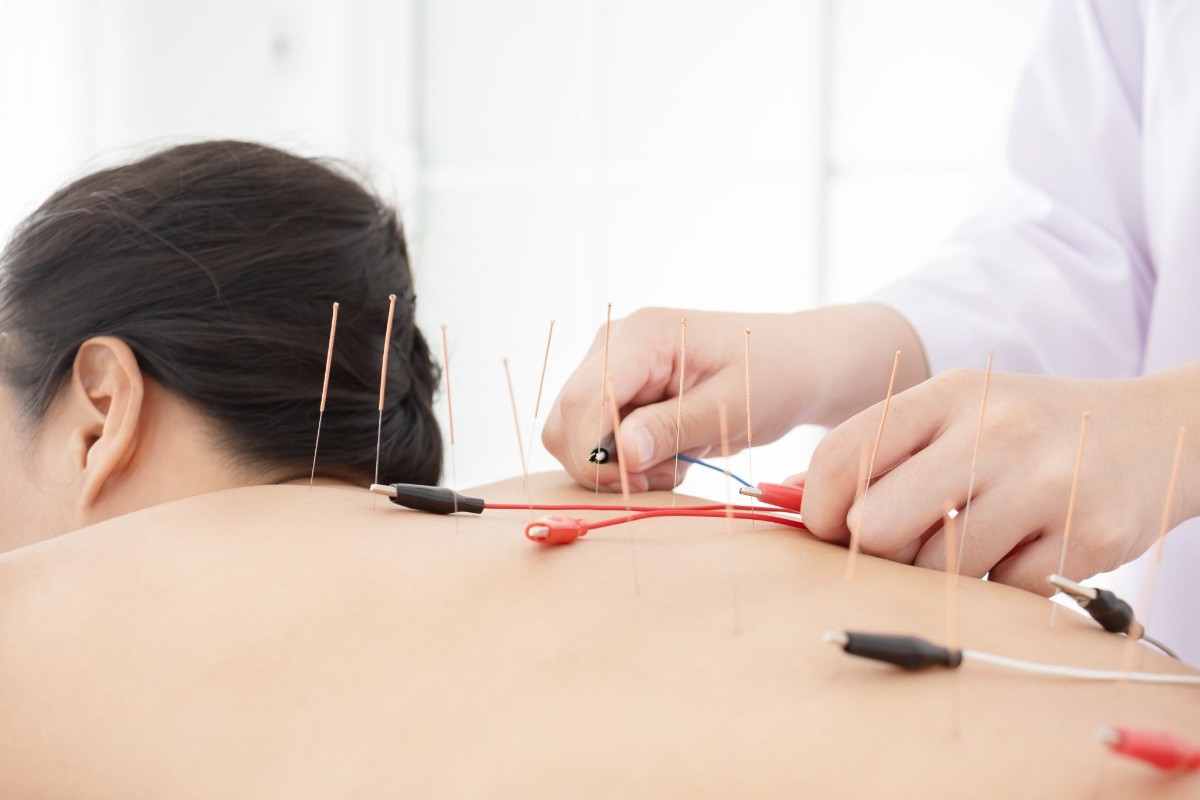 điện châm hỗ trợ chữa viêm khớp