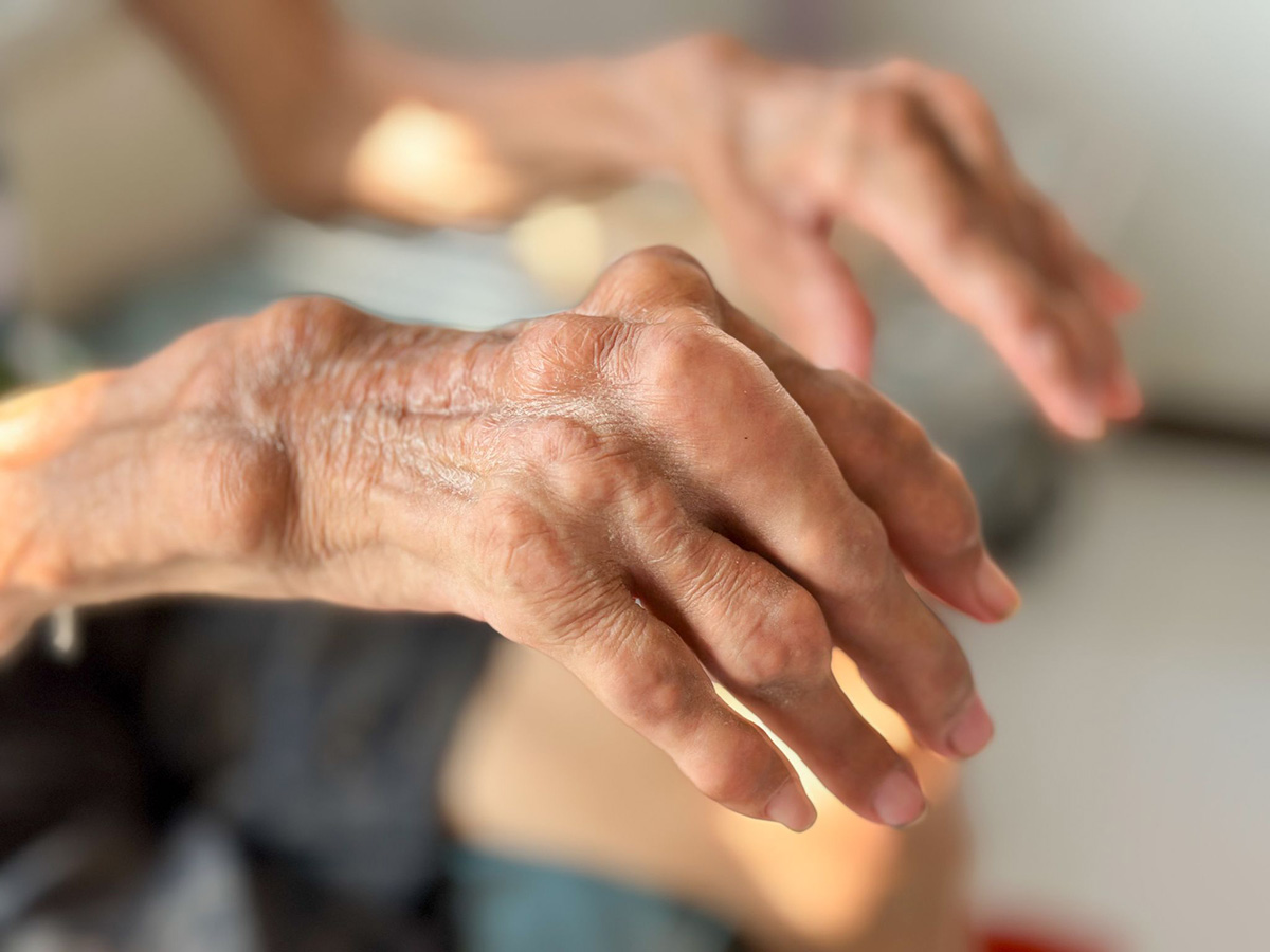 gout là bệnh viêm khớp không đối xứng