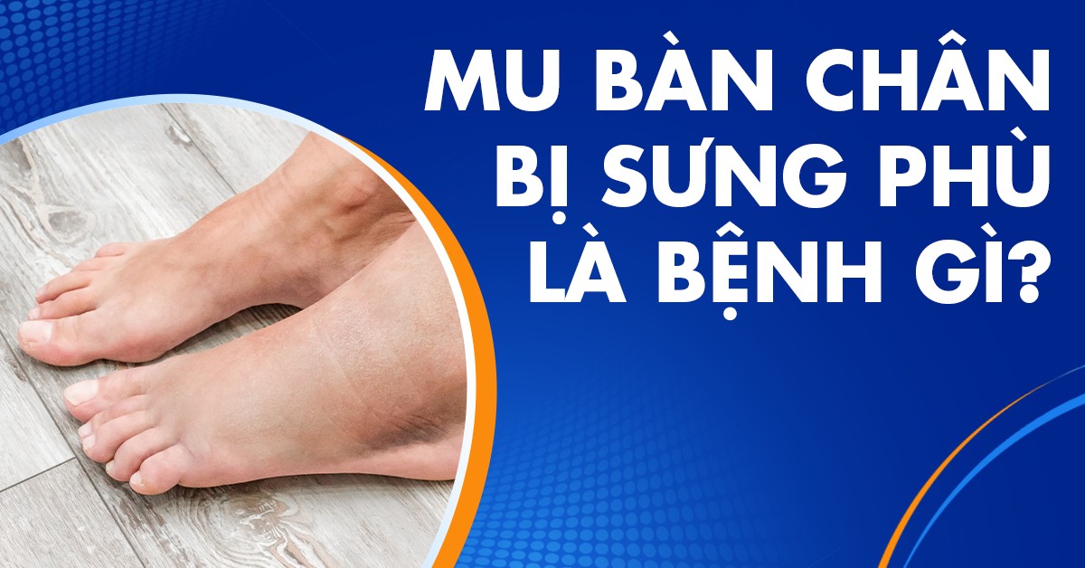 Mu bàn chân bị sưng phù do nguyên nhân gì? Điều trị ra sao?