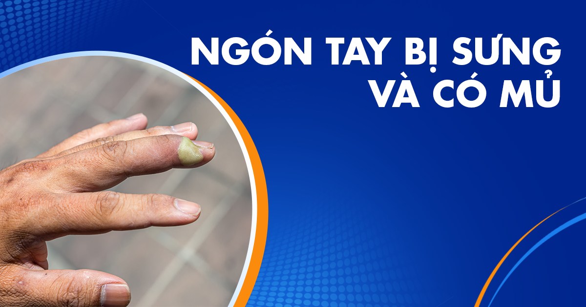 Nếu ngón tay bị sưng và có mủ phải làm sao?