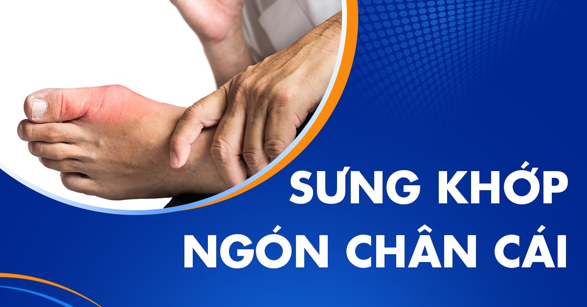Sưng khớp ngón chân cái do đâu? Xử lý sao cho an toàn?
