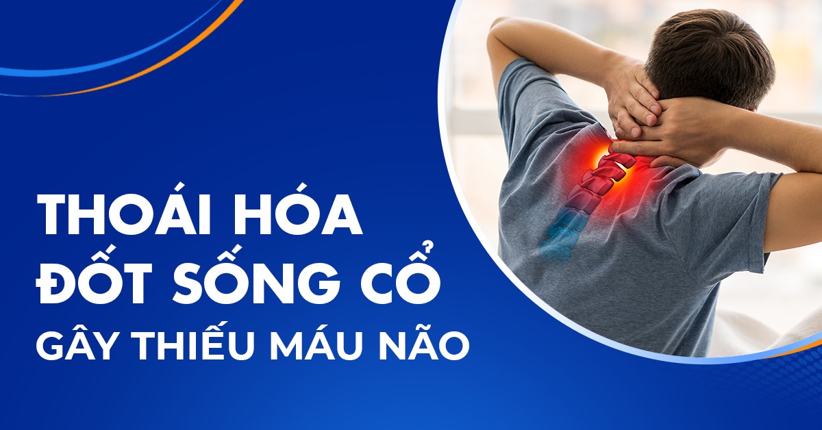 Thoái hóa đốt sống cổ gây thiếu máu não xảy ra như thế nào?