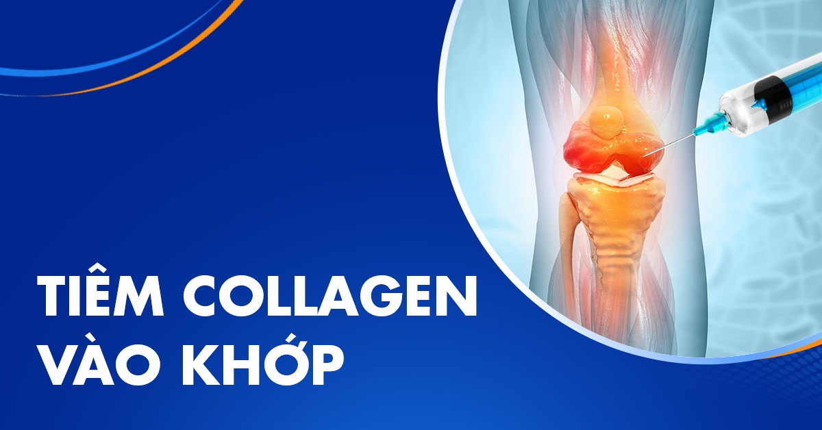 Tiêm collagen vào khớp có tốt không? Quy trình ra sao?