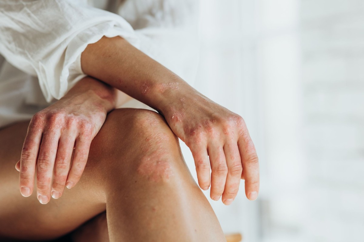 viêm khớp vảy nến gây đau khớp