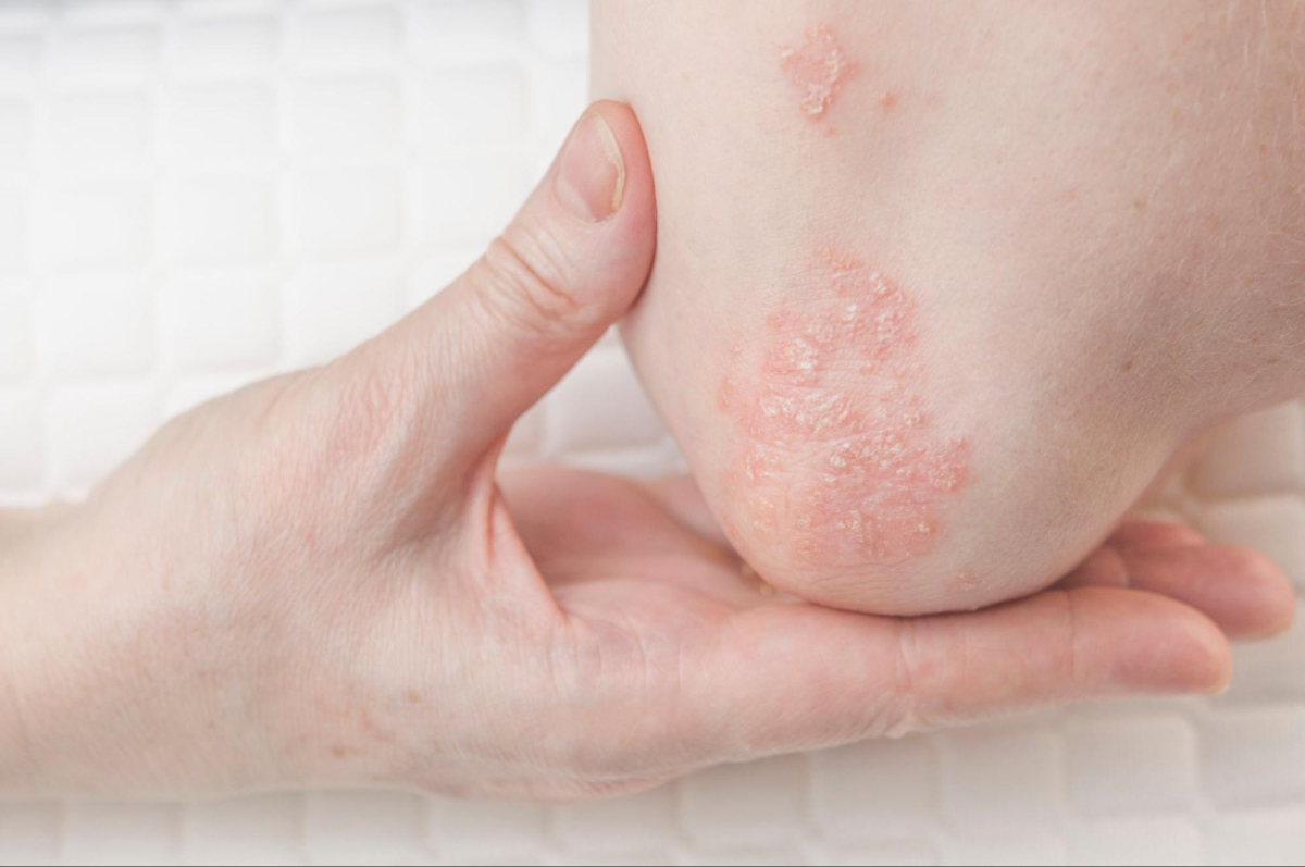 viêm khớp vảy nến