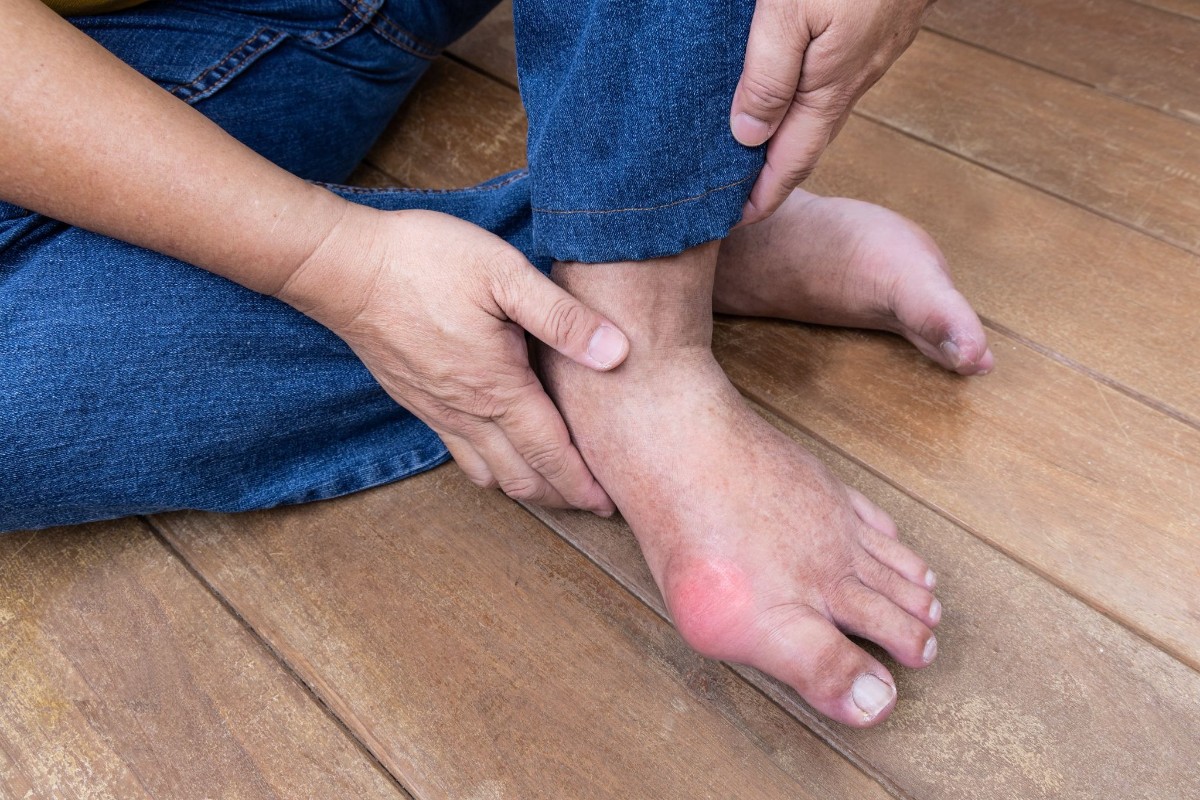 thừa cân béo phì tăng nguy cơ mắc bệnh gout